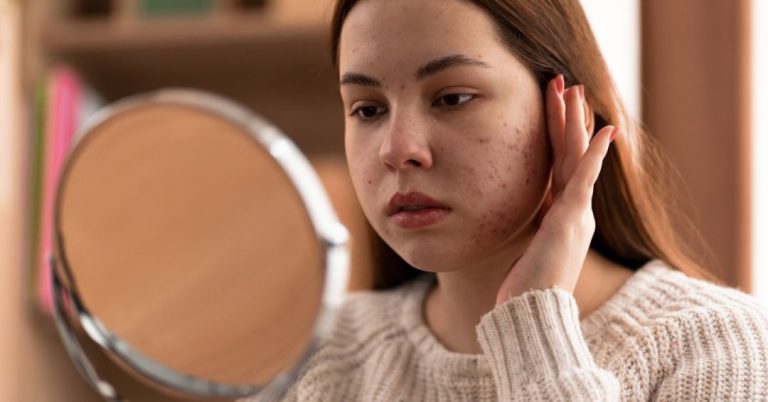 Cuidados com a pele na TPM: o que fazer para evitar espinhas