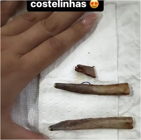 Andressa Urach choca seguidores ao mostrar costelas retiradas para afinar a cintura