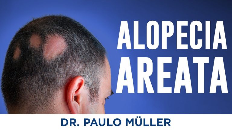 Alopecia Areata (Falhas no Cabelo) – Dr. Paulo Müller Dermatologista