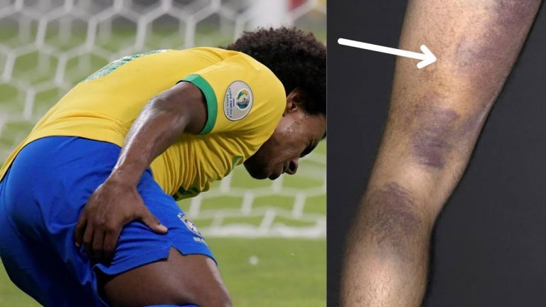 Lesão na posterior da coxa – jogando futebol #musculo #futebol