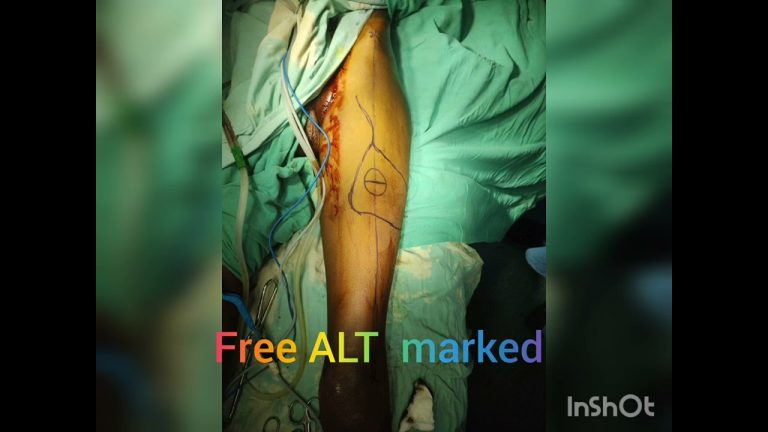 free ALT flap with  vastus lateralis muscle done for nonunited tibial deformity with unstable scar