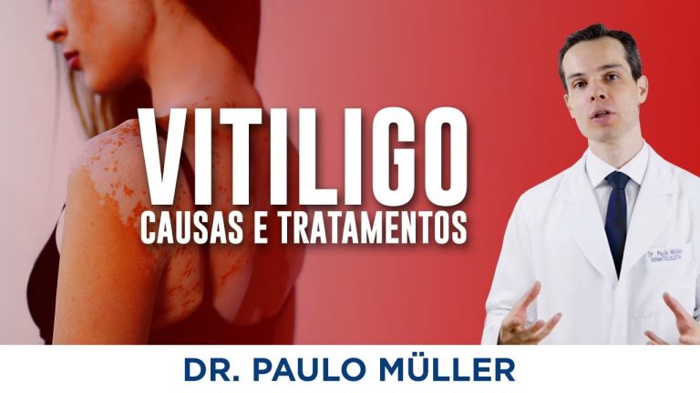 Vitiligo – O que você precisa saber sobre essa doença! – Dr. Paulo Müller Dermatologista