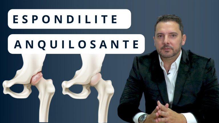 Espondilite Anquilosante