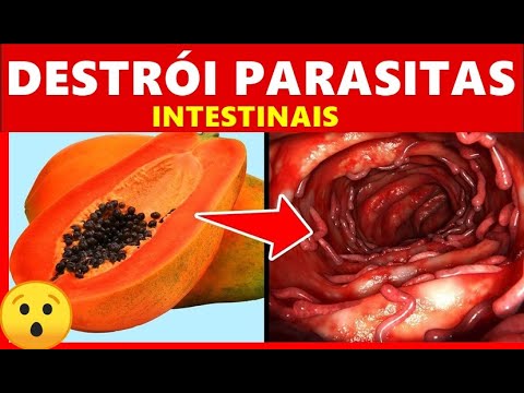 5 Remédios Naturais Para DESTRUIR Parasitas Intestinais