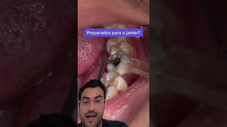 DENTISTA reage a JANTAR DENTRO DO DENTE!