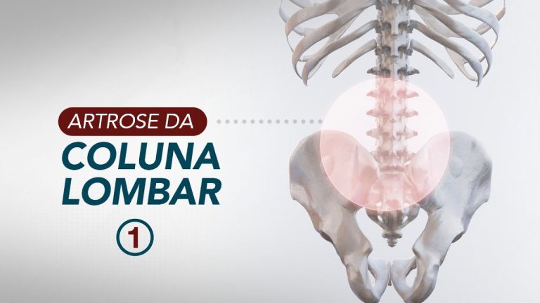 Artrose da coluna: O que é e como diagnosticar?