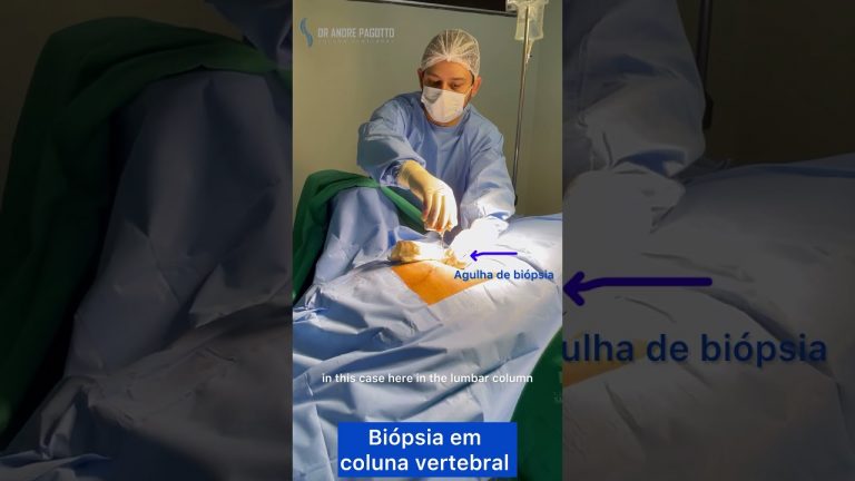 Biópsia em coluna vertebral nos casos de suspeita de tumor ou infecção #especialistaemcoluna #tumor